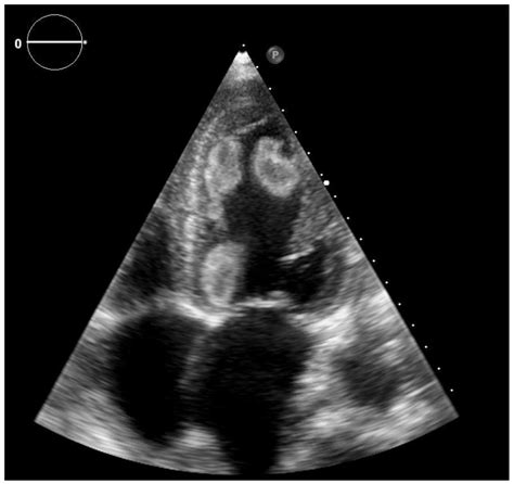 lv clot on echo|echocardiography for Lv thrombus.